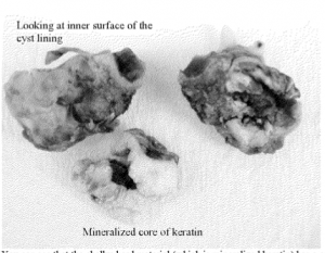 Photos of the bone pieces removed